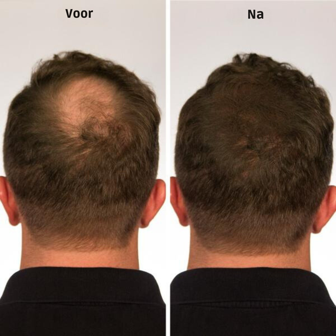 VelourHair™ | Geen kale plekken meer!