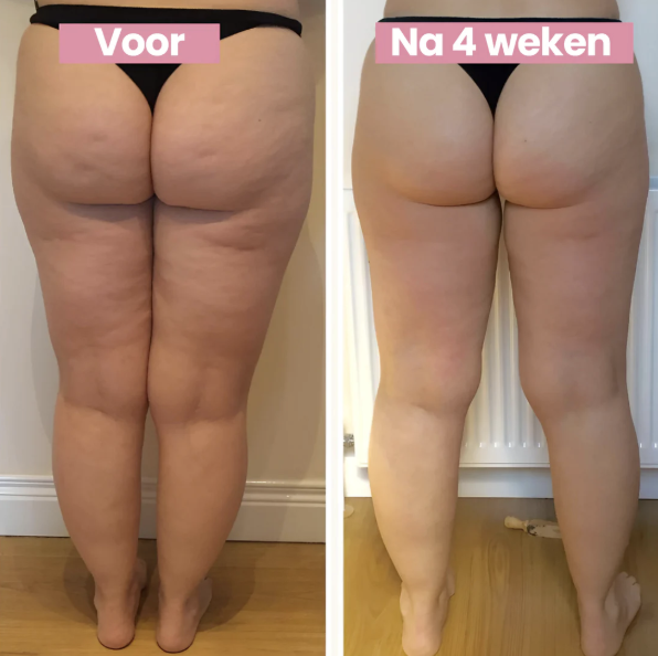 GlowSculpt™ | Pakt hardnekkige cellulite aan