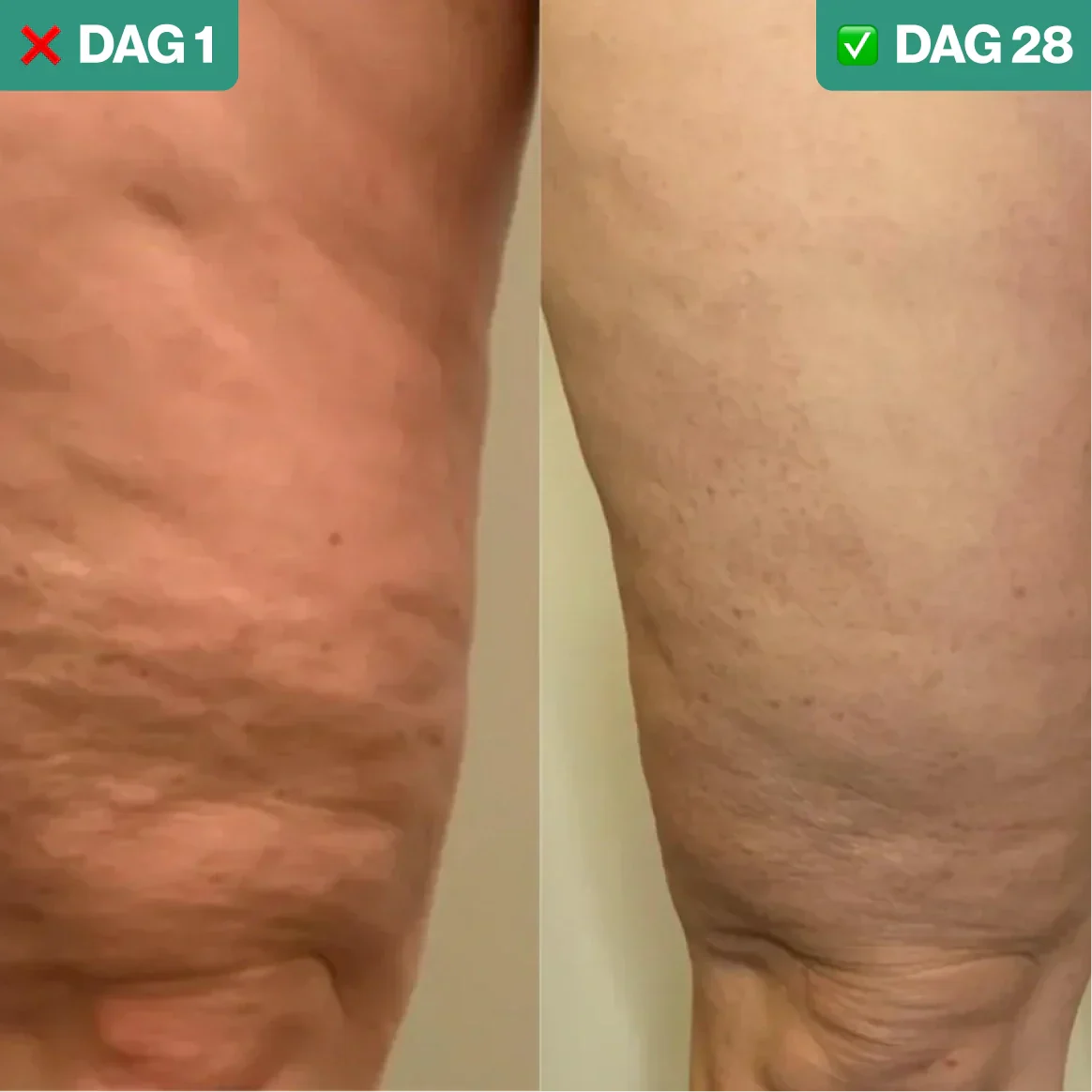 GlowSculpt™ | Pakt hardnekkige cellulite aan