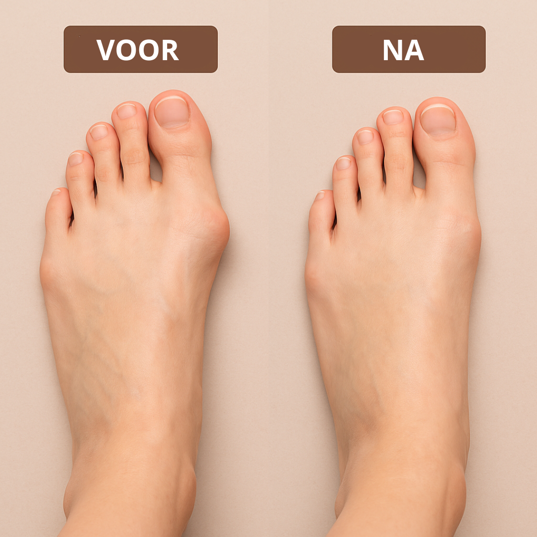 BunionRelief™ | Corrigeer pijnlijke knobbels